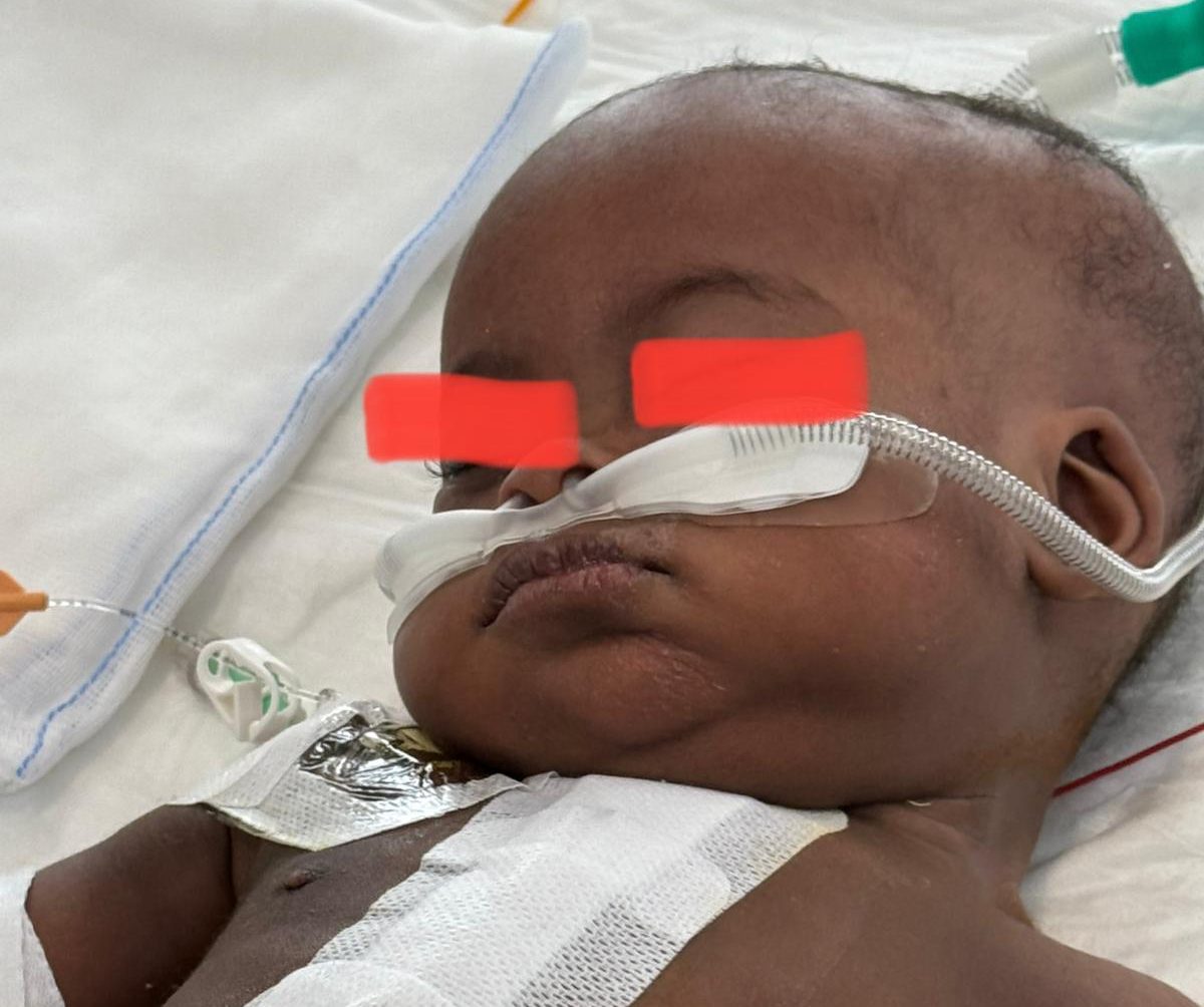 Salvata bimba africana alla Cardiochirurgia di Taormina